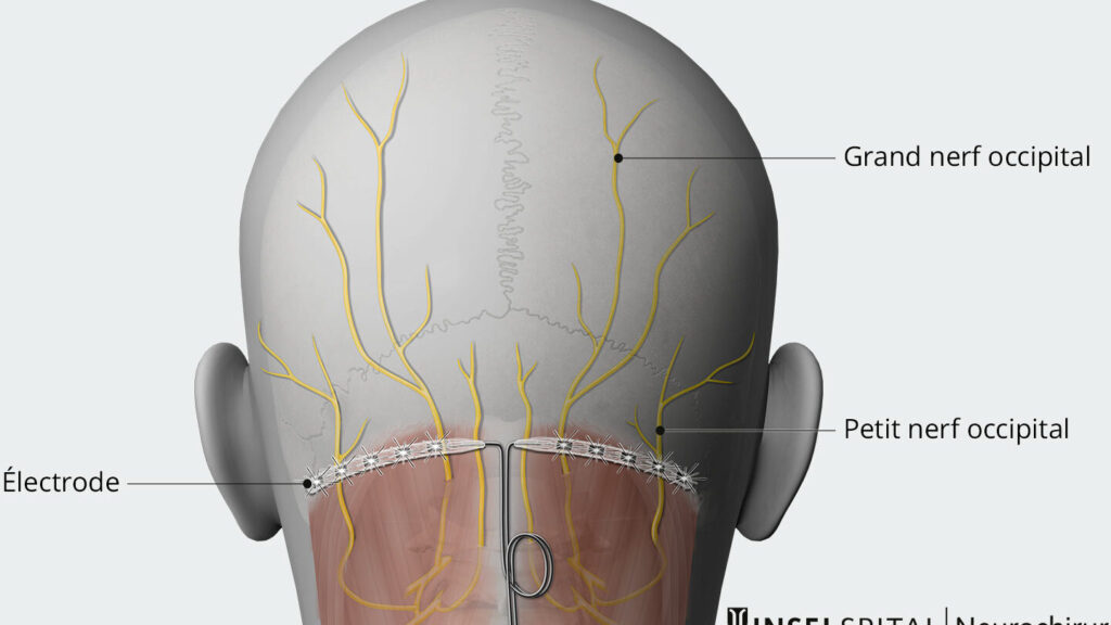 Soulagement des maux de tête en grappe : quelles sont les options disponibles ?