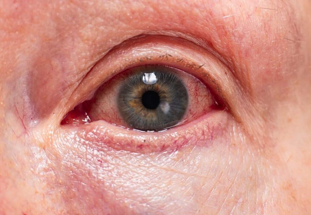 Abrasion cornéenne : que faire en cas de rayure sur l’œil ?