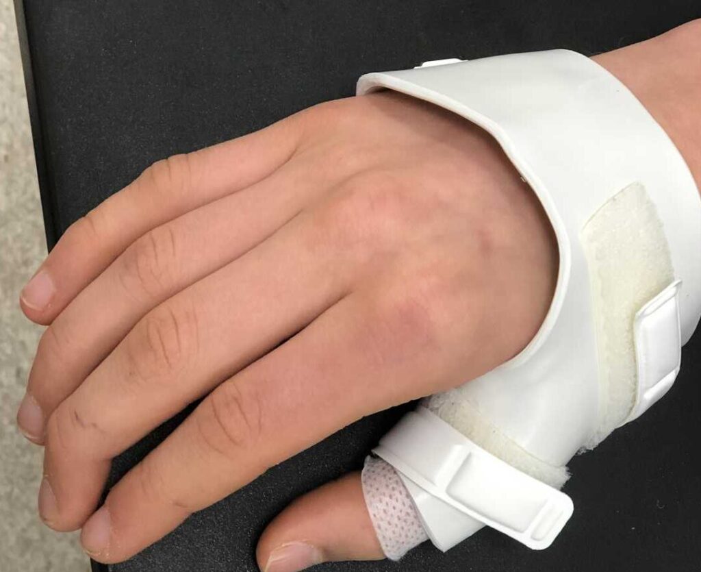 Comment reconnaître et traiter un pouce foulé ?
