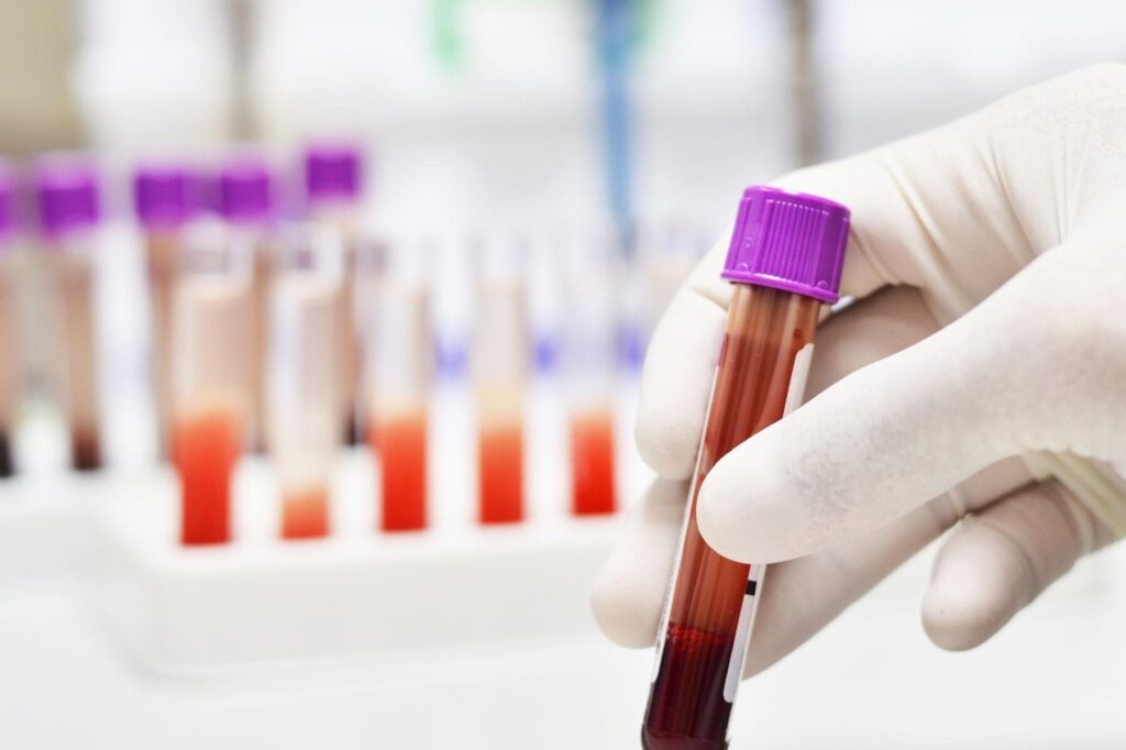Comprendre votre bilan d’hémolyse : causes et interprétations