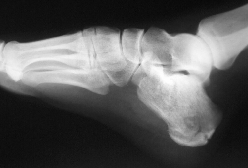 Micro fissure osseuse du talon : symptômes, traitements et prévention