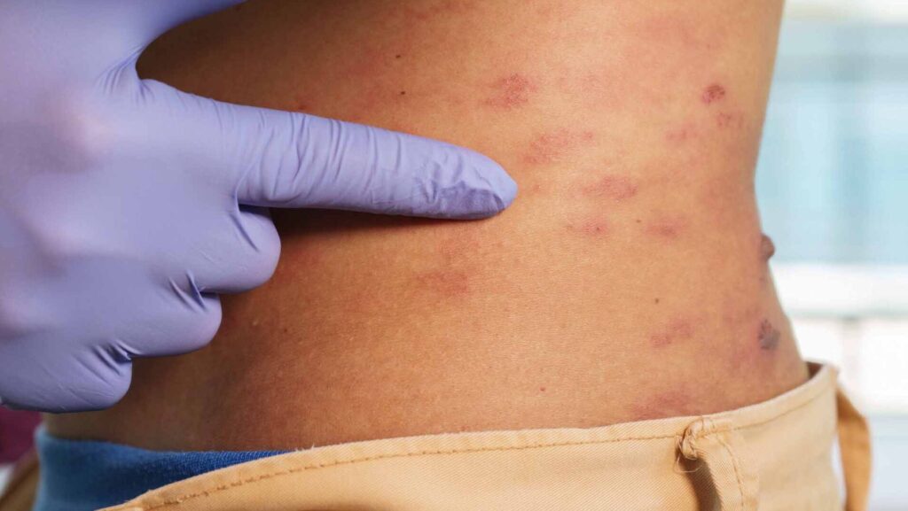 Comment atténuer les cicatrices laissées par le zona ?