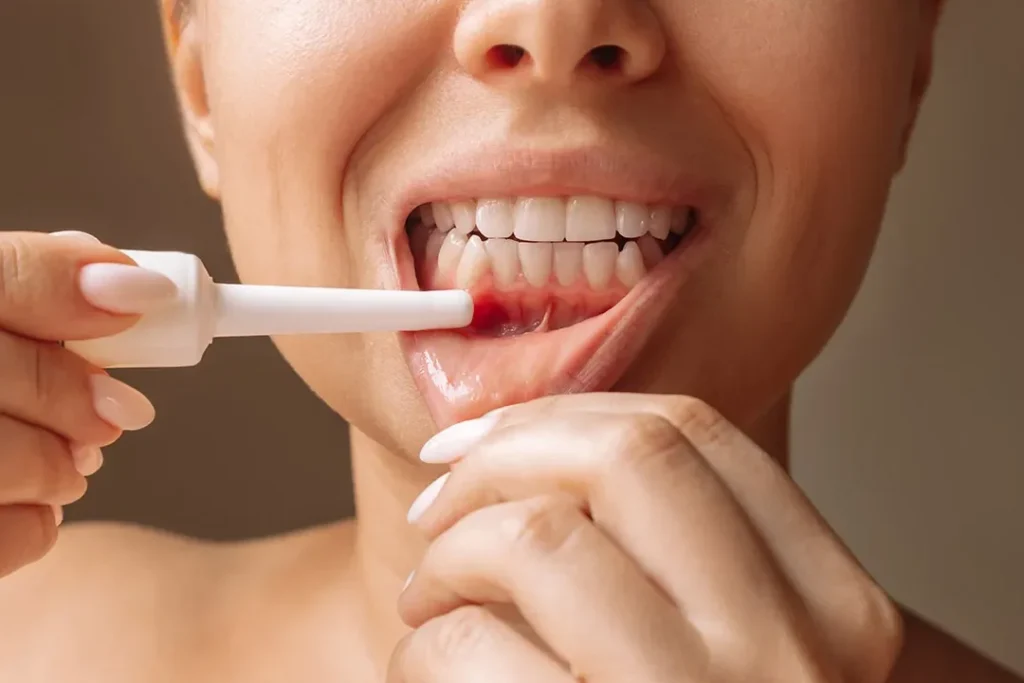 Comment reconnaître et traiter la stomatite ulcéreuse ?