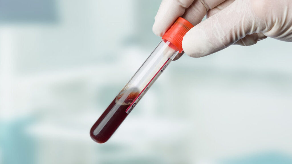 Comprendre l’importance de l’osmolarité plasmatique normale pour votre santé