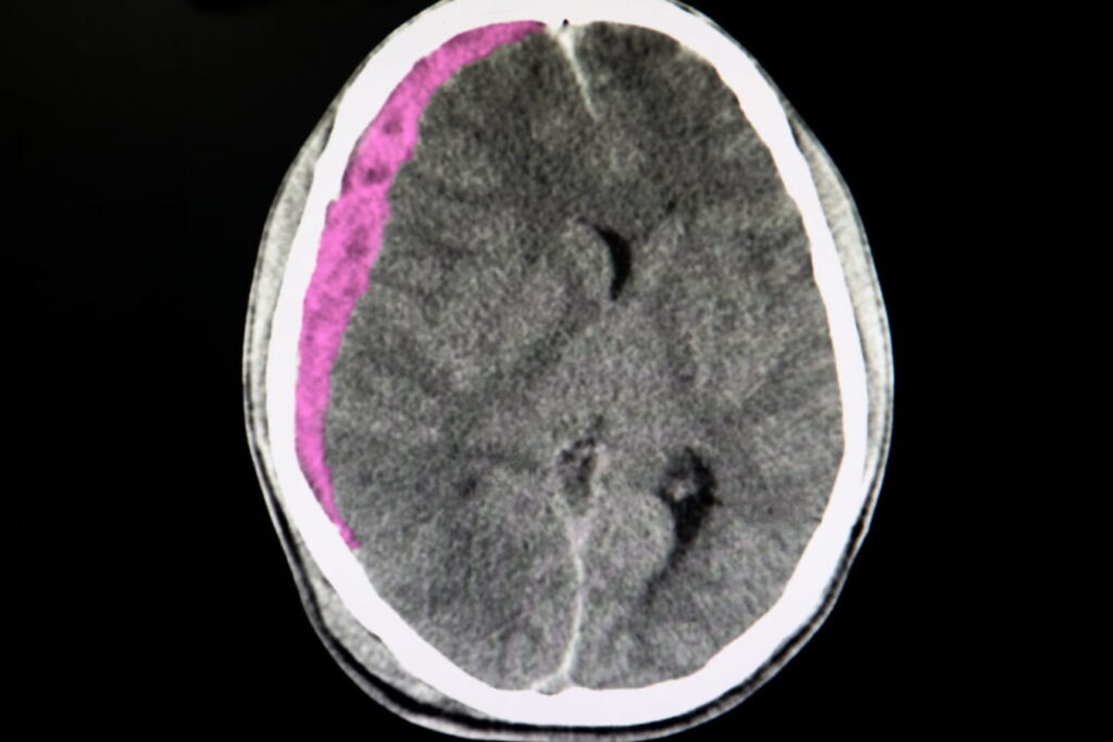 Hématome intracrânien : comment le reconnaître et le traiter ?