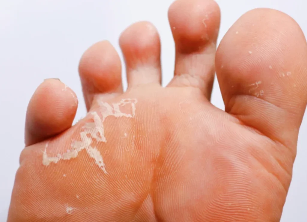 Comment soigner naturellement les tinea pedis ?
