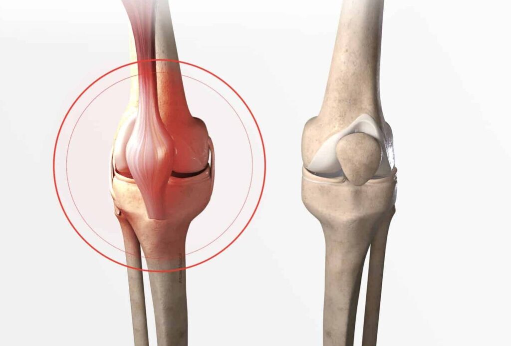 Comment soulager la douleur du ligament externe du genou ?