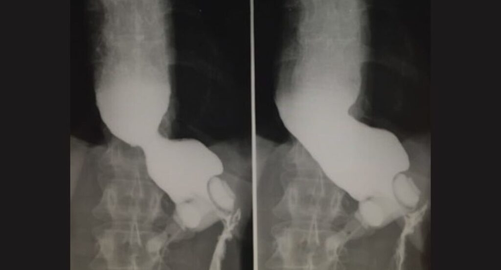 Comprendre le diagnostic de hernie hiatale à travers une radiographie