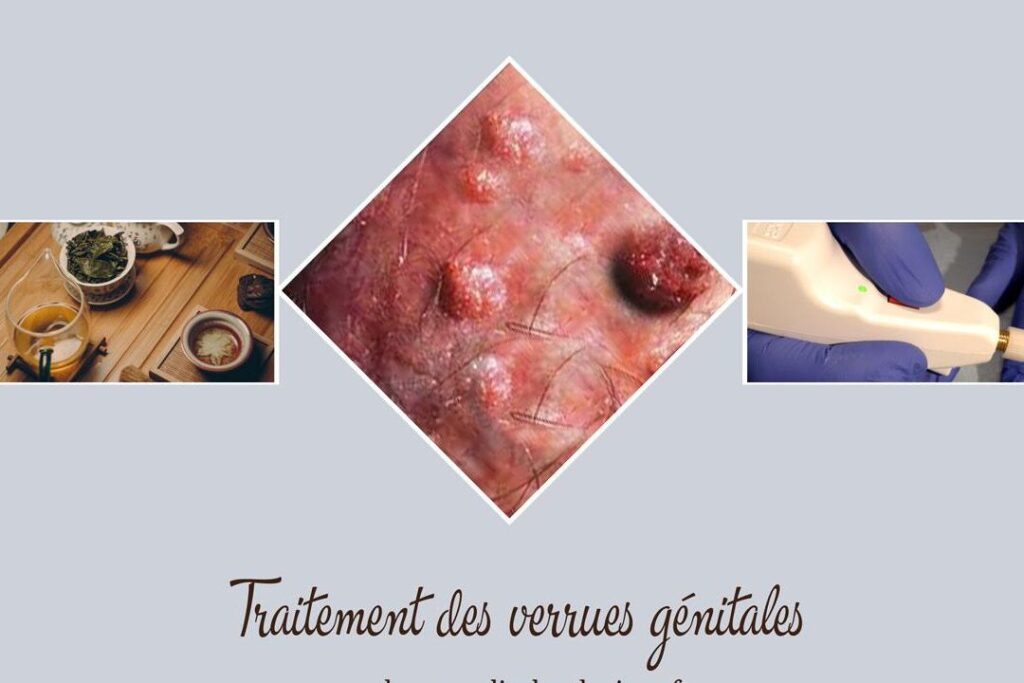 Photos de verrues génitales chez l&rsquo;homme : comment les identifier ?
