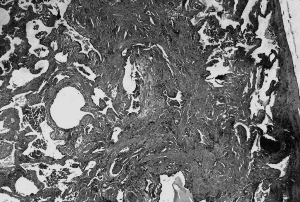 Pneumopathie organisée cryptogénique : comment la reconnaître et la traiter ?