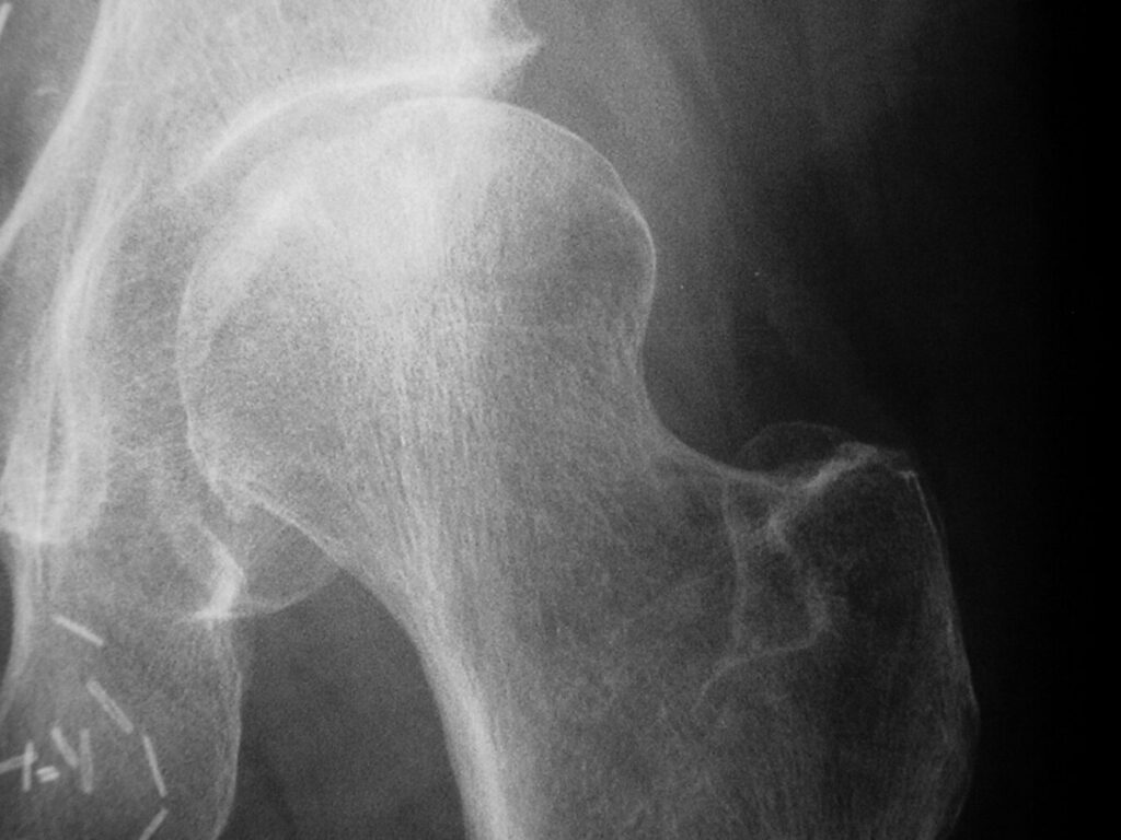 Signe du flot genou : comment le reconnaître et que faire ?
