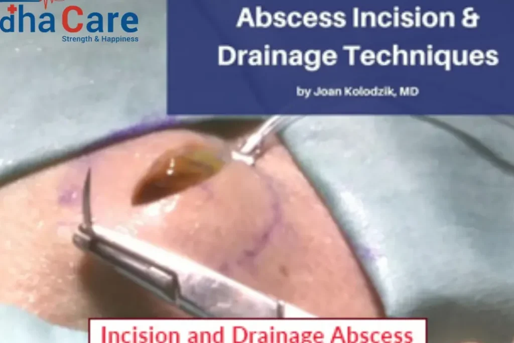 Incision d’un abcès : guide étape par étape pour une procédure sûre
