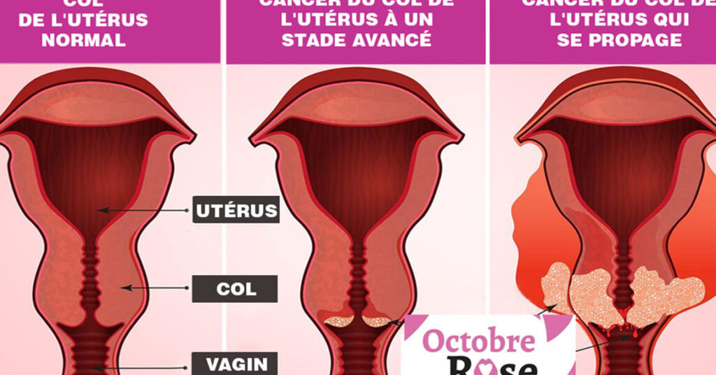 Quels sont les premiers symptômes du cancer de l’utérus au stade 1 à surveiller ?