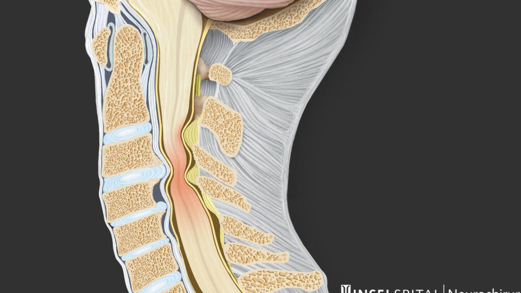 Rétrécissement du canal cervical : symptômes, causes et traitements efficaces