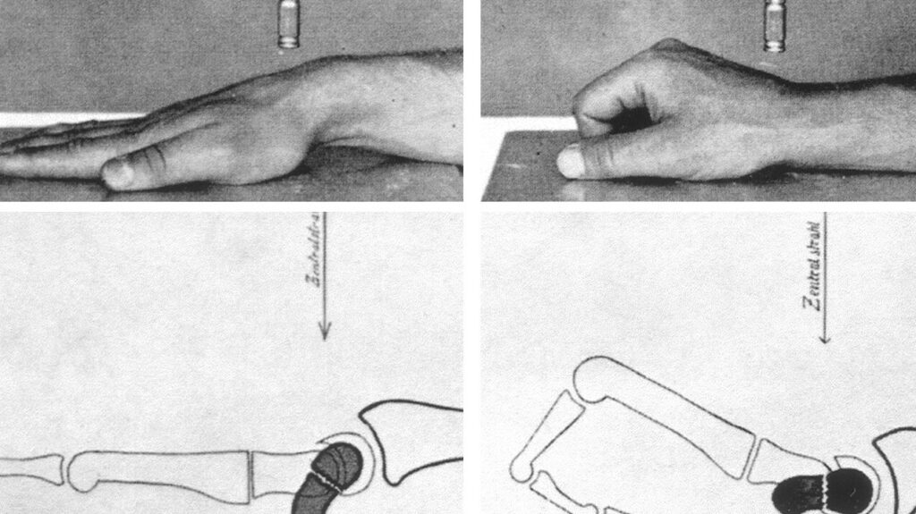 Traits de fracture : comment les détecter et prévenir les complications ?