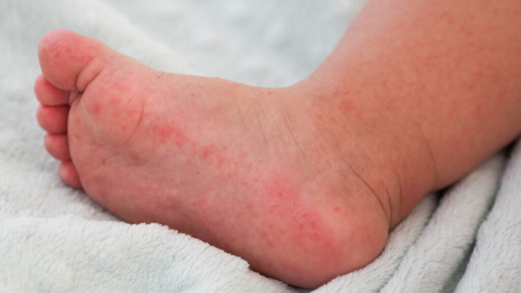 Érythermalgie des pieds : symptômes, causes et traitements efficaces