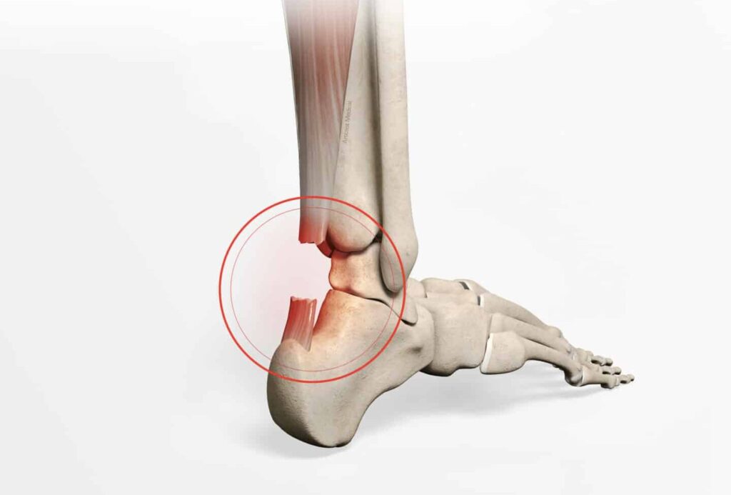 Guérison d’une rupture partielle du tendon d’Achille sans chirurgie: Quelles sont les options ?