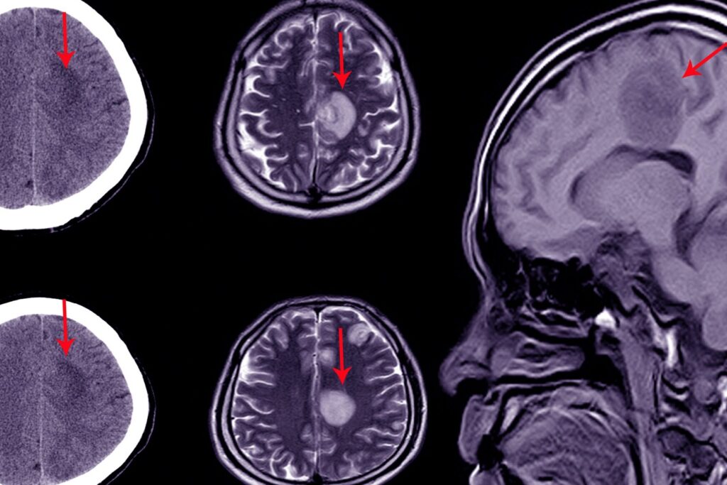 Hémorragie sous-arachnoïdienne : causes, symptômes et traitements essentiels à connaître