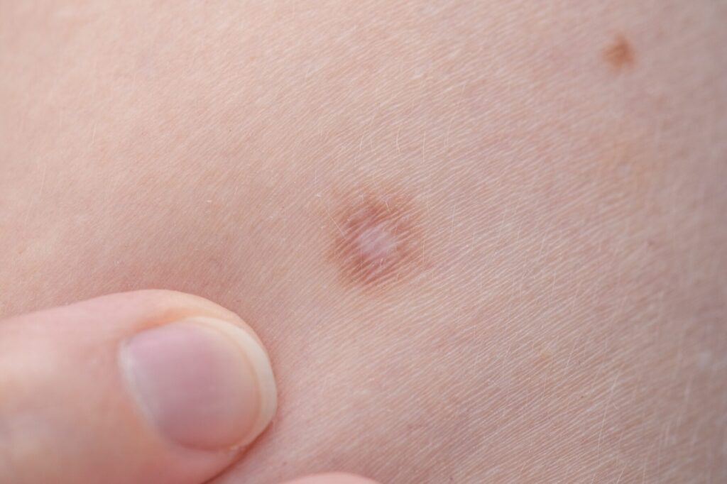 Quelles sont les causes de l’histiocytofibrome ?