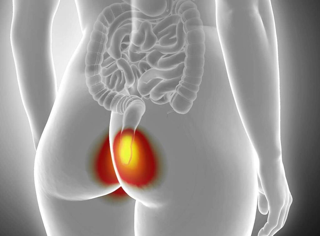 Fissures intestinales : comment les identifier et les traiter ?
