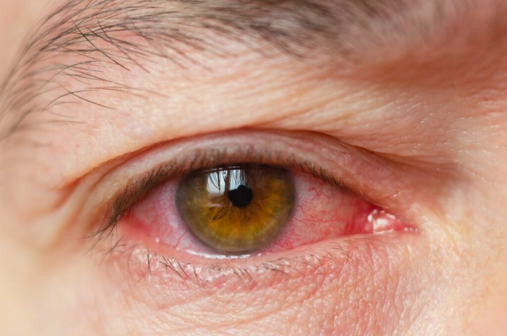 Glaucome aigu par fermeture de l’angle : symptômes, traitements et prévention