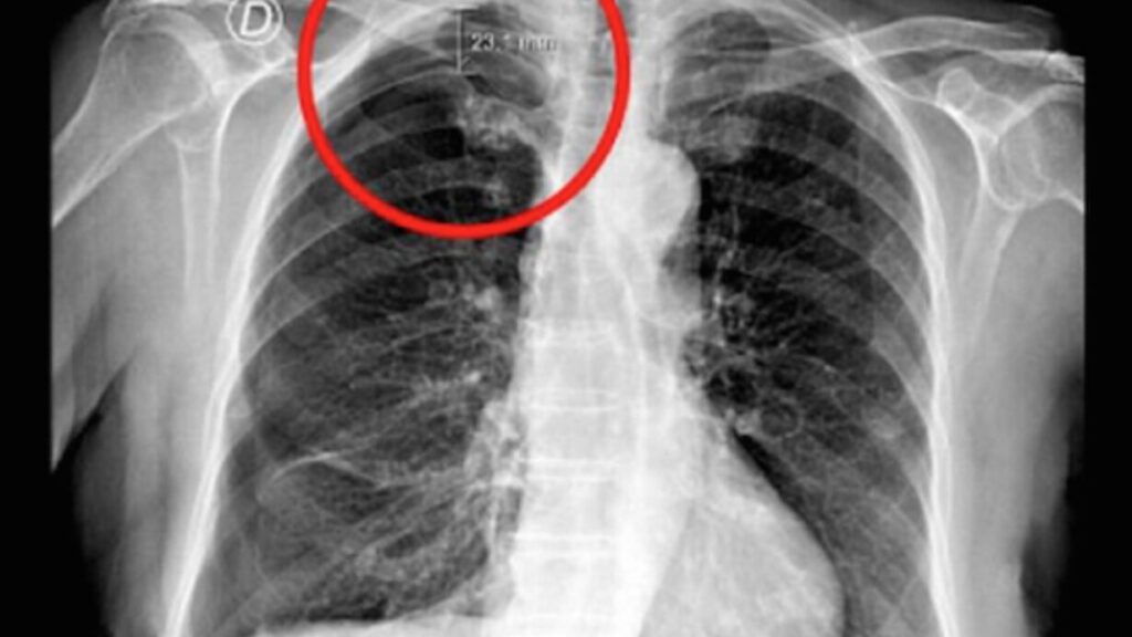 Poumon perforé : combien de temps pour une guérison complète ?