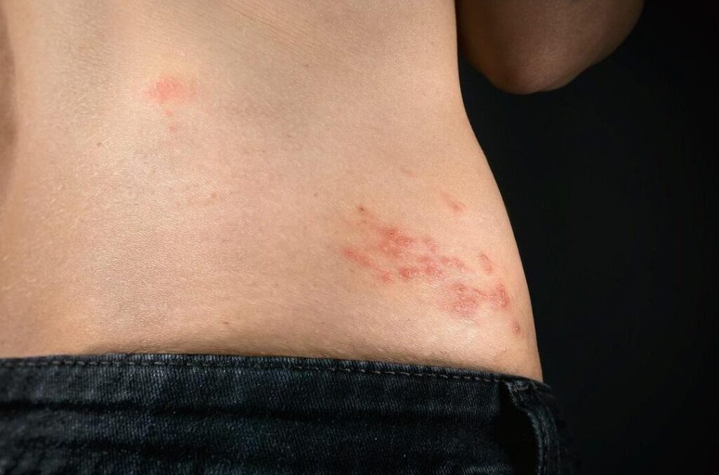 Zona et herpes : comprendre les différences et les traitements efficaces