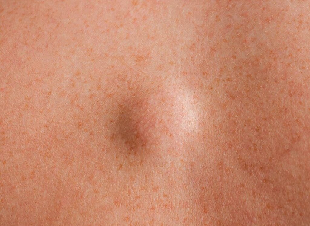 Comment identifier un kyste pilonidal ? Photos et conseils de reconnaissance