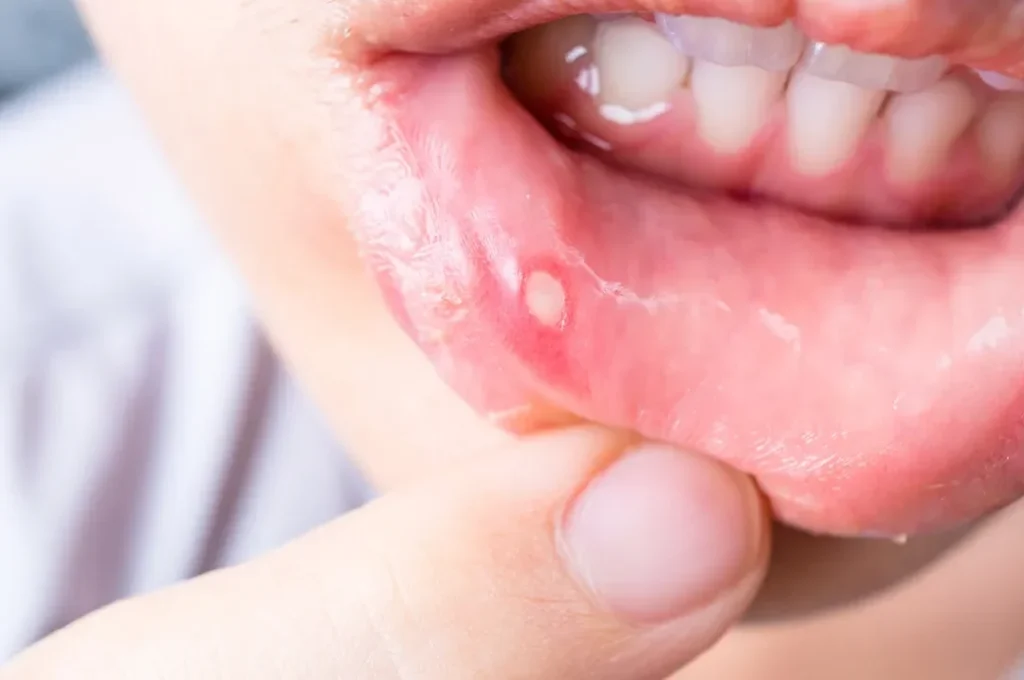 Comment traiter les brûlures dans la bouche de manière efficace ?