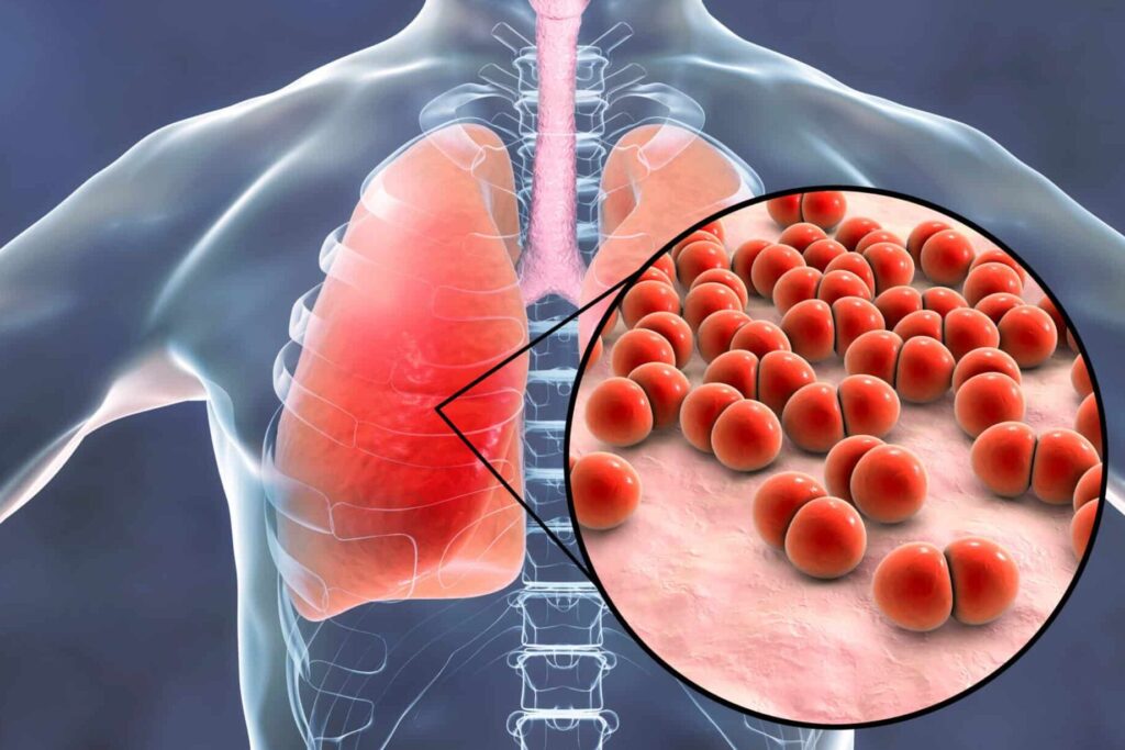 Comprendre la miliaire pulmonaire : symptômes, causes et traitements