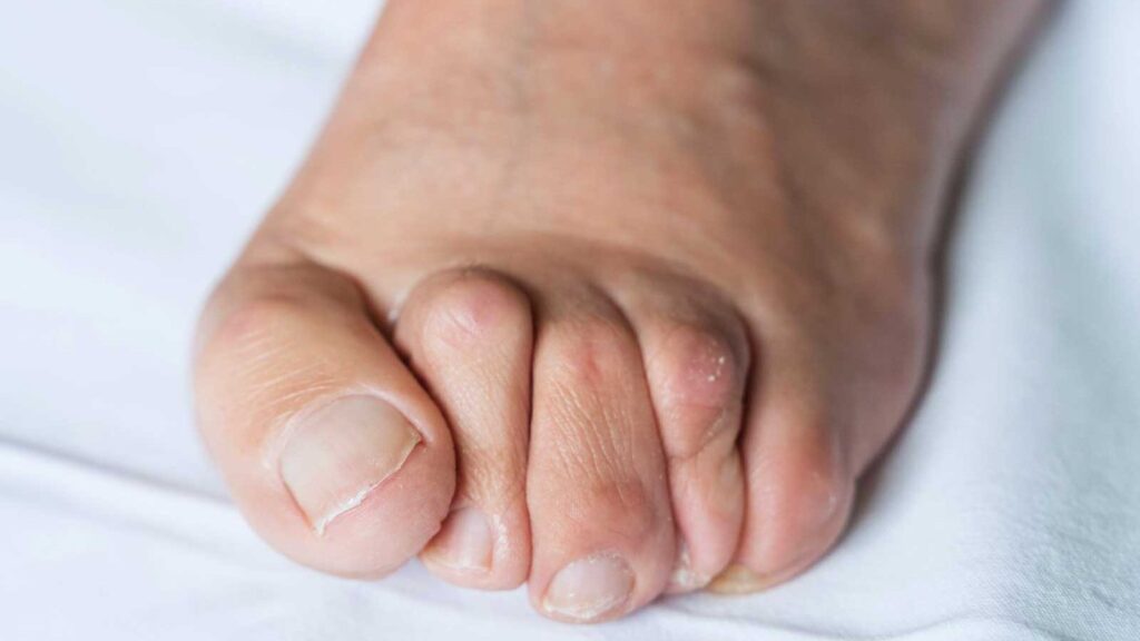 Pied en marteau : causes, symptômes et traitements efficaces