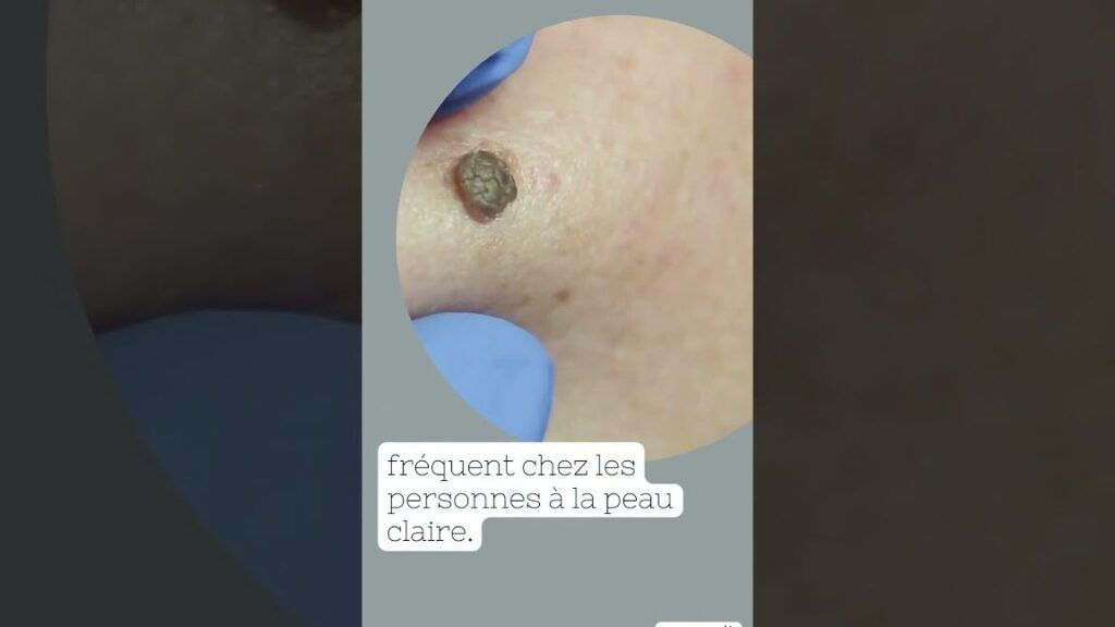 Rachitisme vitamino-résistant : comment le reconnaître et le traiter efficacement ?