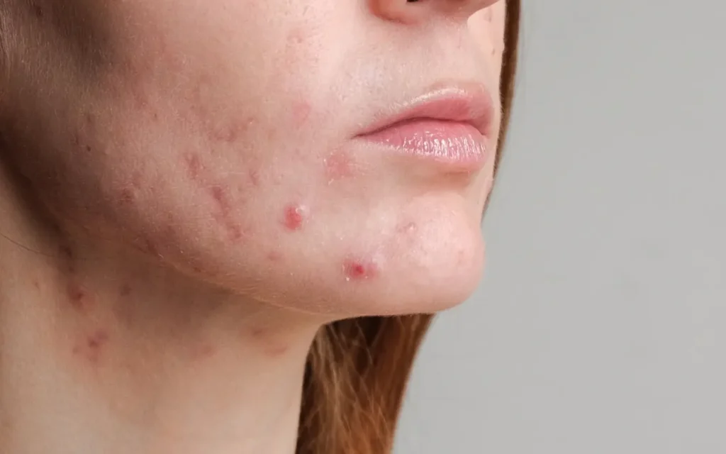 Reconnaître les symptômes du syndrome des ovaires polykystiques : êtes-vous concernée ?