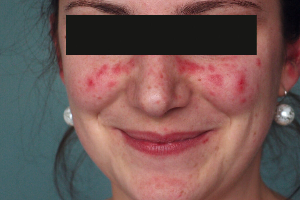 Compléments C3 et C4 : des biomarqueurs clés pour comprendre le lupus
