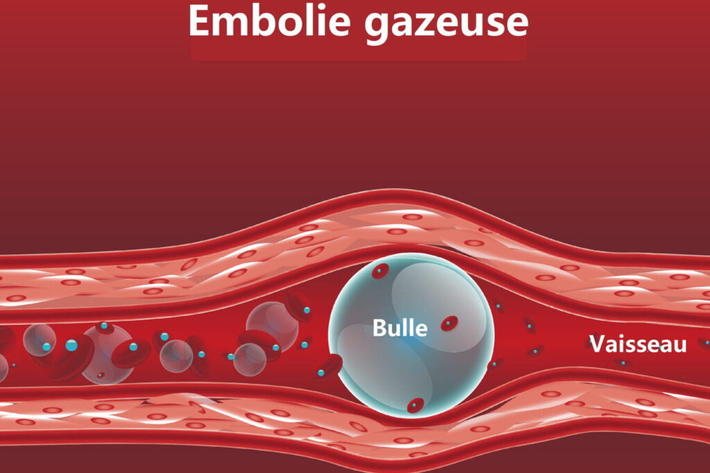 Emboulie gazeuse veineuse : combien de temps avant l&rsquo;apparition des symptômes ?