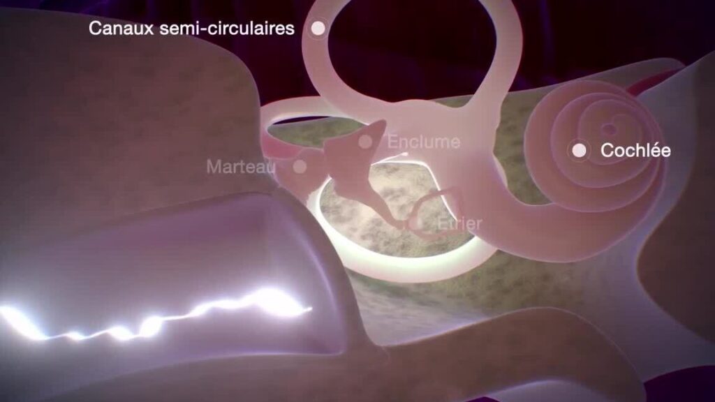 Neurinome de l’oreille : quels sont les signes et comment le traiter ?