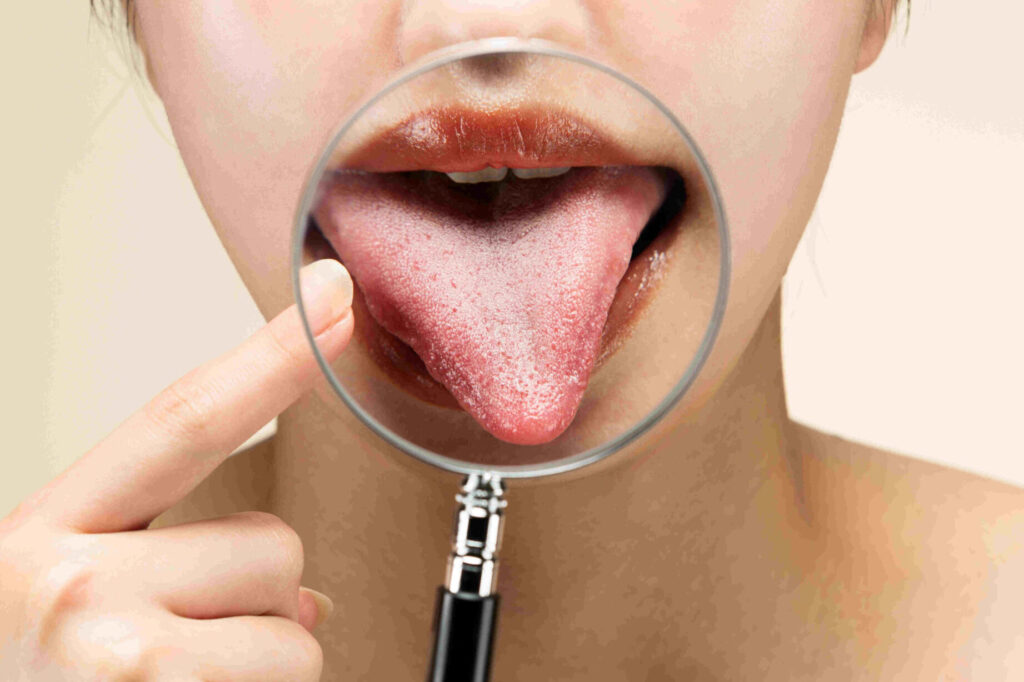 Comment soigner une plaie sur la langue efficacement ?