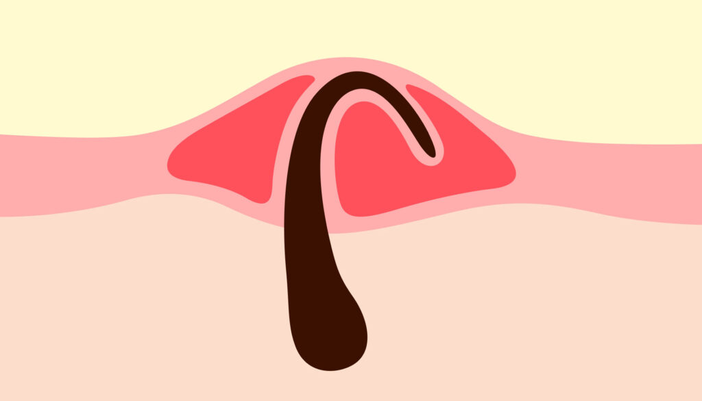 Comment traiter et prévenir les poils incarnés dans la barbe ?