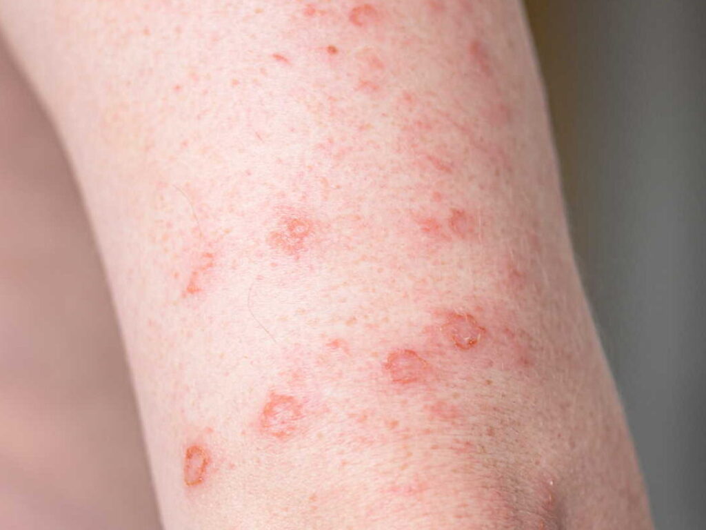 Images de chancre syphilitique : ce qu’il faut savoir pour reconnaître les premiers signes de la syphilis