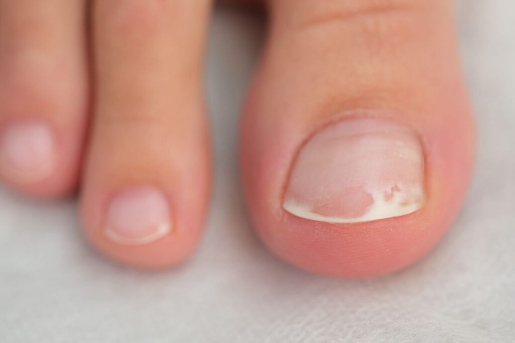 Koilonychie : que révèlent vos ongles concaves sur votre santé ?