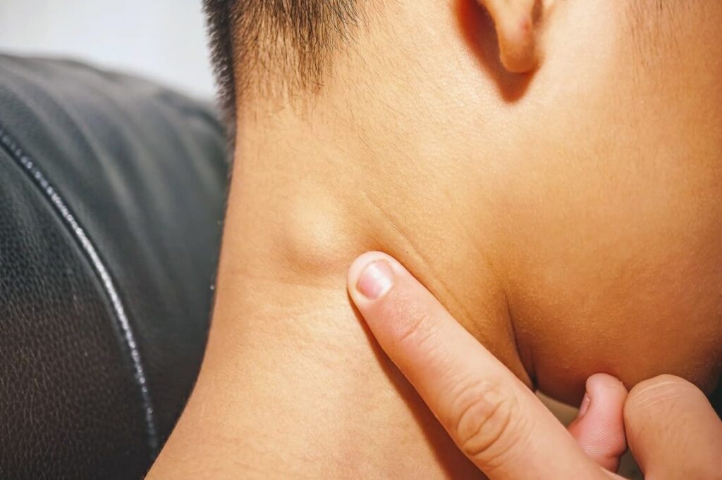 Lymphadénopathie : comment reconnaître et traiter l’inflammation des ganglions lymphatiques ?